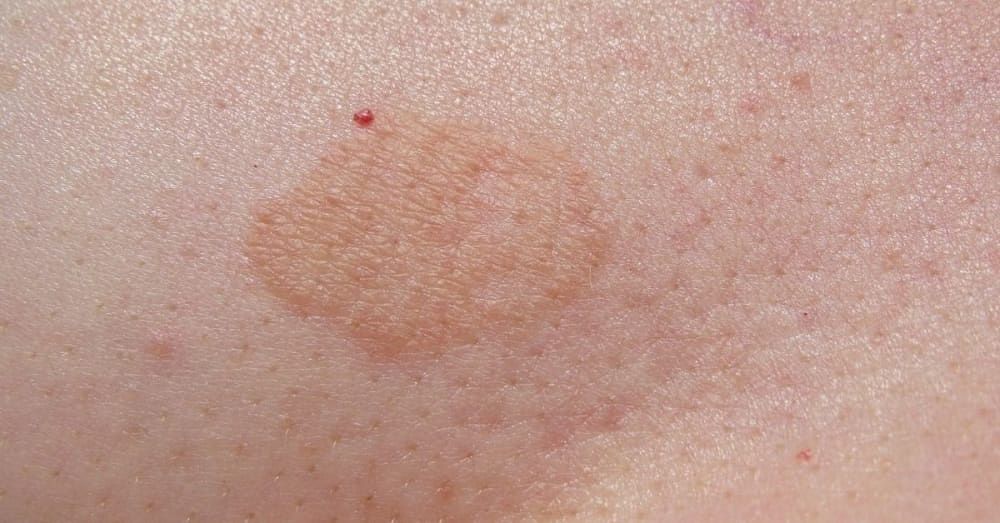 Yeast fungal shop skin infection